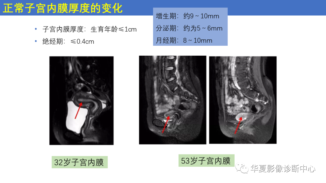 影像PPT - 【PPT】子宫内膜疾病的MRI诊断及鉴别-7