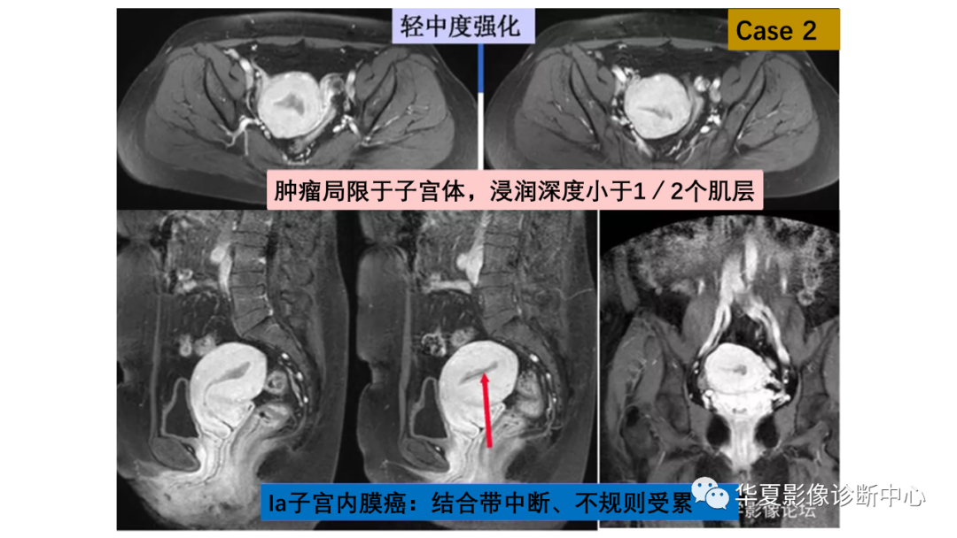 影像PPT - 【PPT】子宫内膜疾病的MRI诊断及鉴别-14