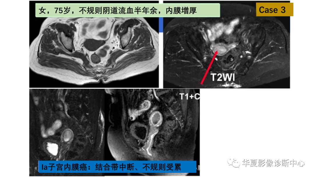 影像PPT - 【PPT】子宫内膜疾病的MRI诊断及鉴别-15