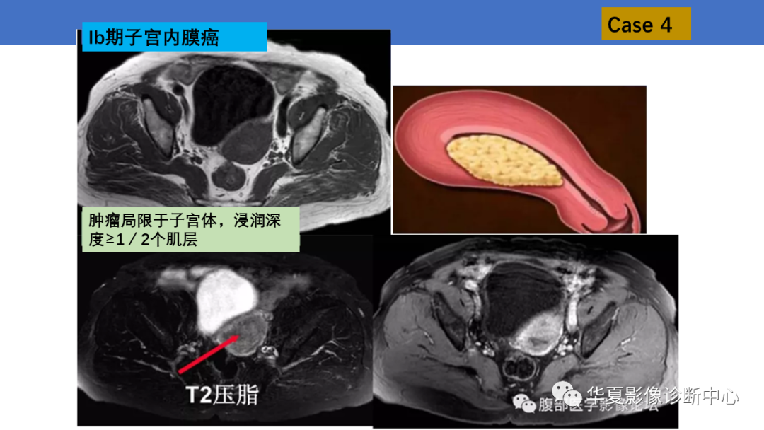 影像PPT - 【PPT】子宫内膜疾病的MRI诊断及鉴别-17