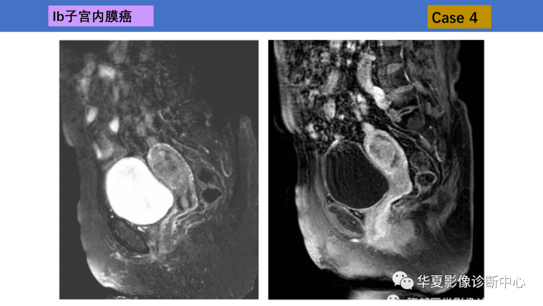 影像PPT - 【PPT】子宫内膜疾病的MRI诊断及鉴别-18