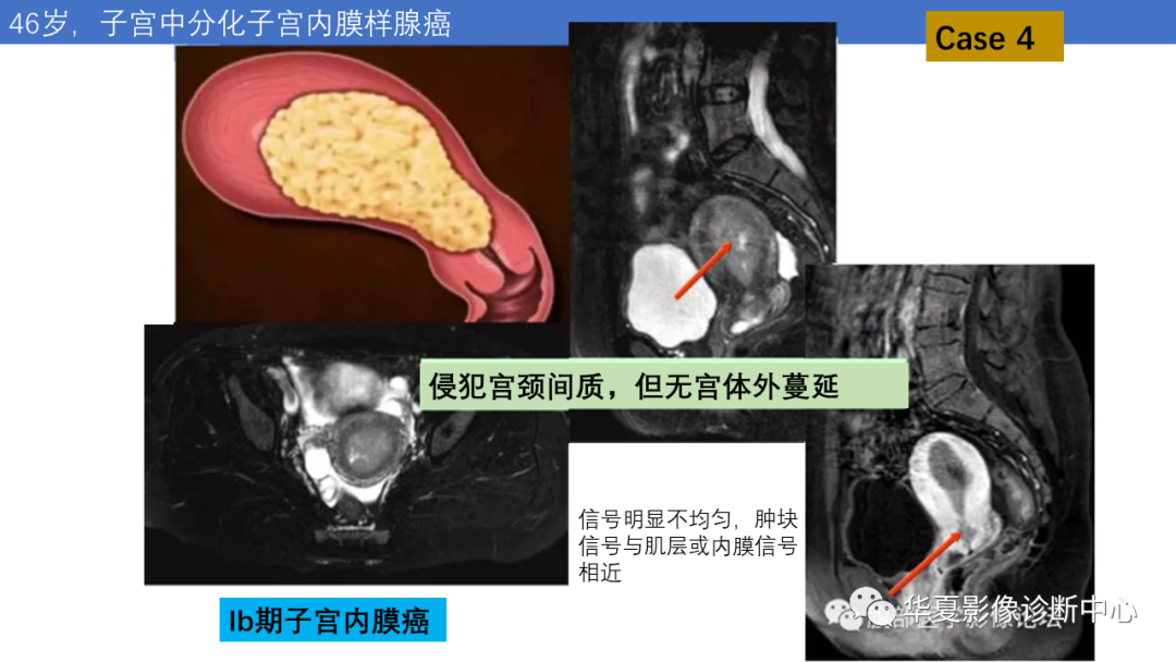 影像PPT - 【PPT】子宫内膜疾病的MRI诊断及鉴别-19