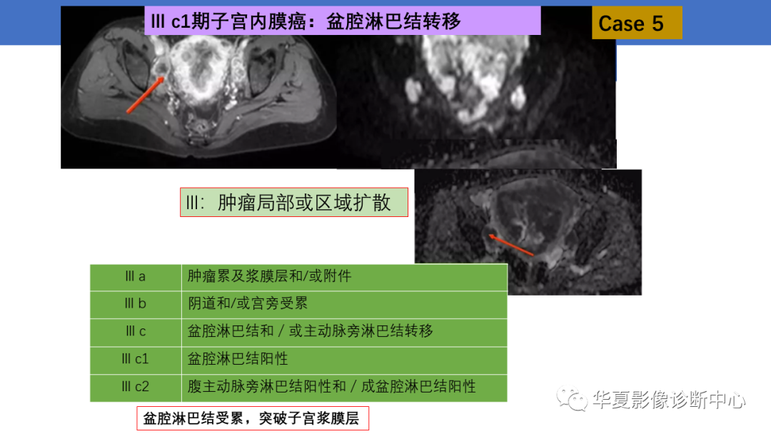 影像PPT - 【PPT】子宫内膜疾病的MRI诊断及鉴别-21