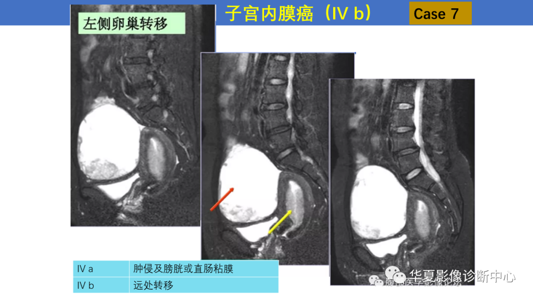 影像PPT - 【PPT】子宫内膜疾病的MRI诊断及鉴别-23