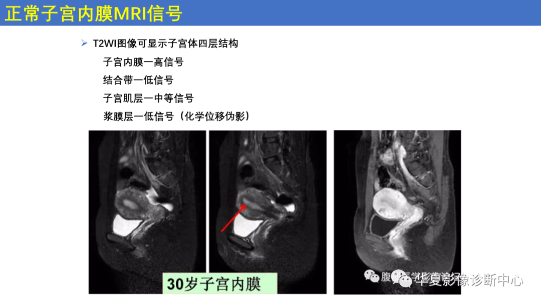 影像PPT - 【PPT】子宫内膜疾病的MRI诊断及鉴别-8