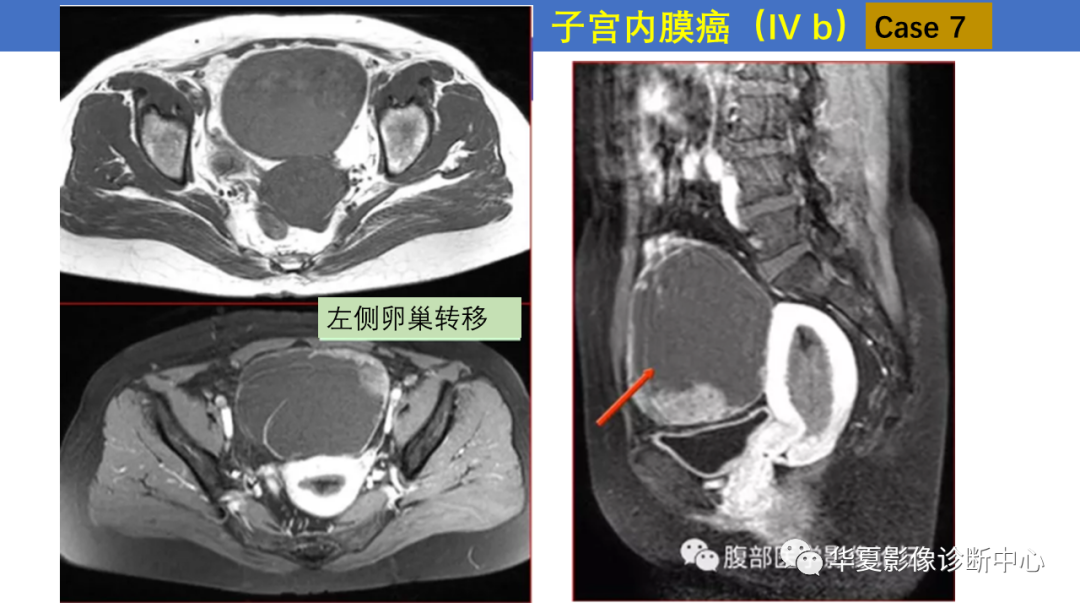 影像PPT - 【PPT】子宫内膜疾病的MRI诊断及鉴别-24