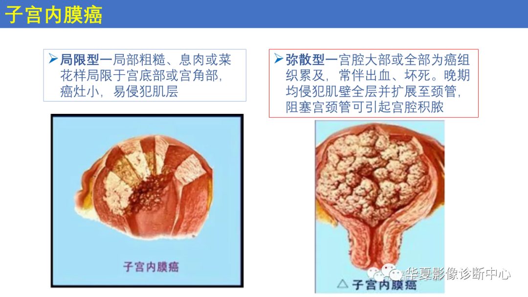 影像PPT - 【PPT】子宫内膜疾病的MRI诊断及鉴别-26