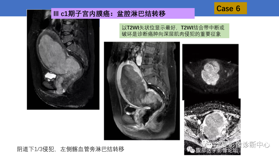 影像PPT - 【PPT】子宫内膜疾病的MRI诊断及鉴别-22