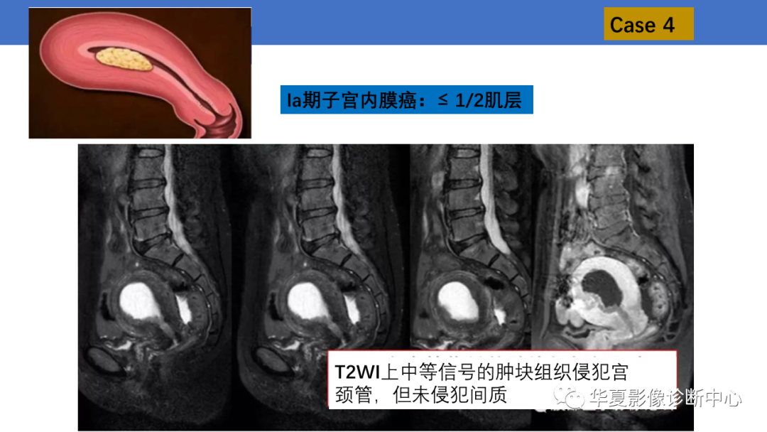 影像PPT - 【PPT】子宫内膜疾病的MRI诊断及鉴别-16