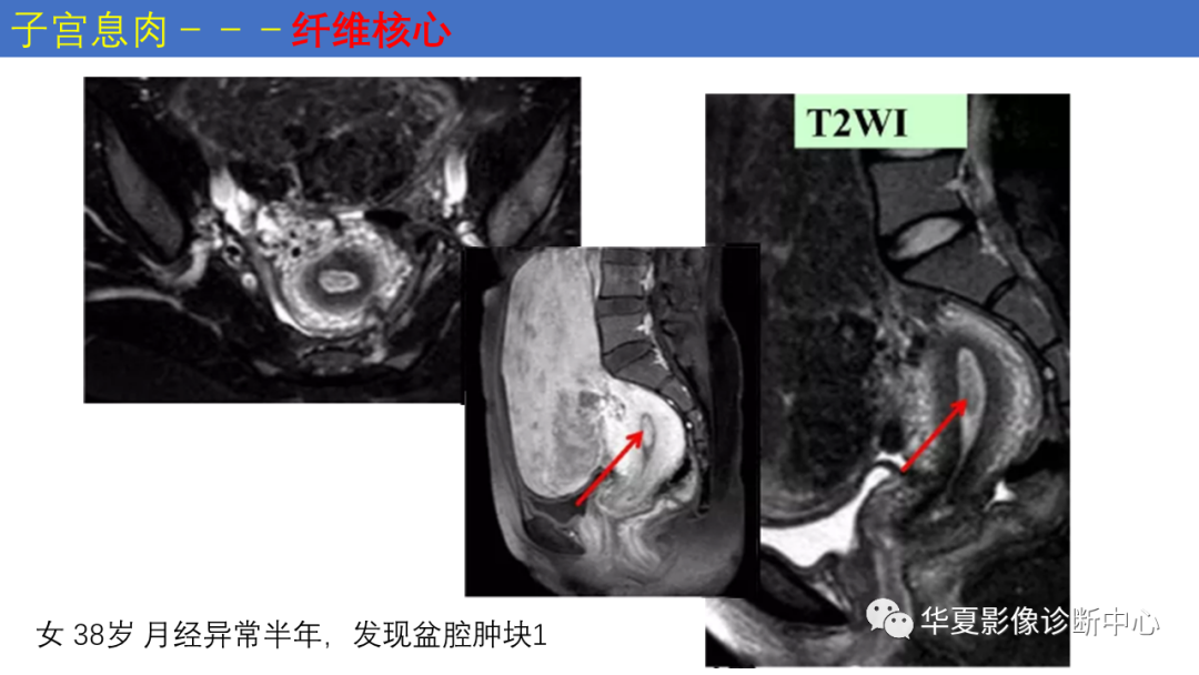 影像PPT - 【PPT】子宫内膜疾病的MRI诊断及鉴别-31