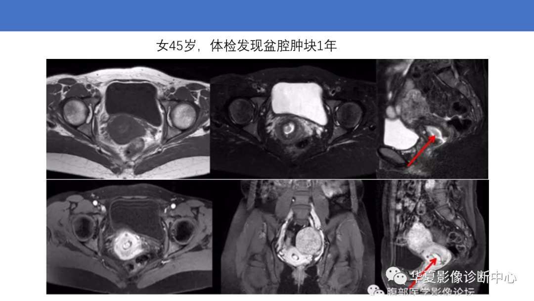 影像PPT - 【PPT】子宫内膜疾病的MRI诊断及鉴别-32