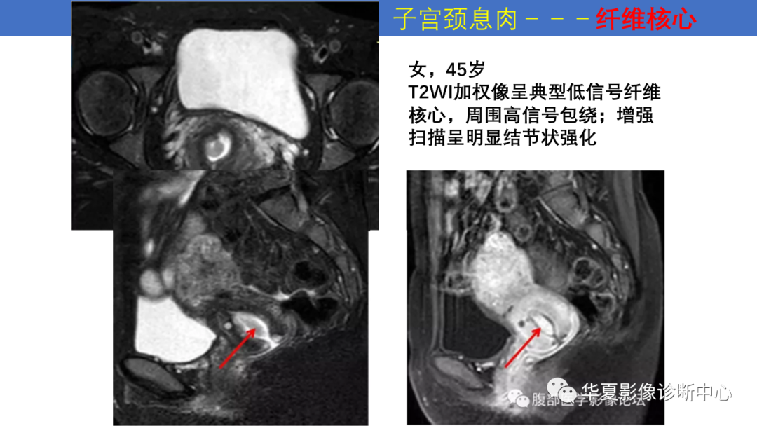 影像PPT - 【PPT】子宫内膜疾病的MRI诊断及鉴别-33