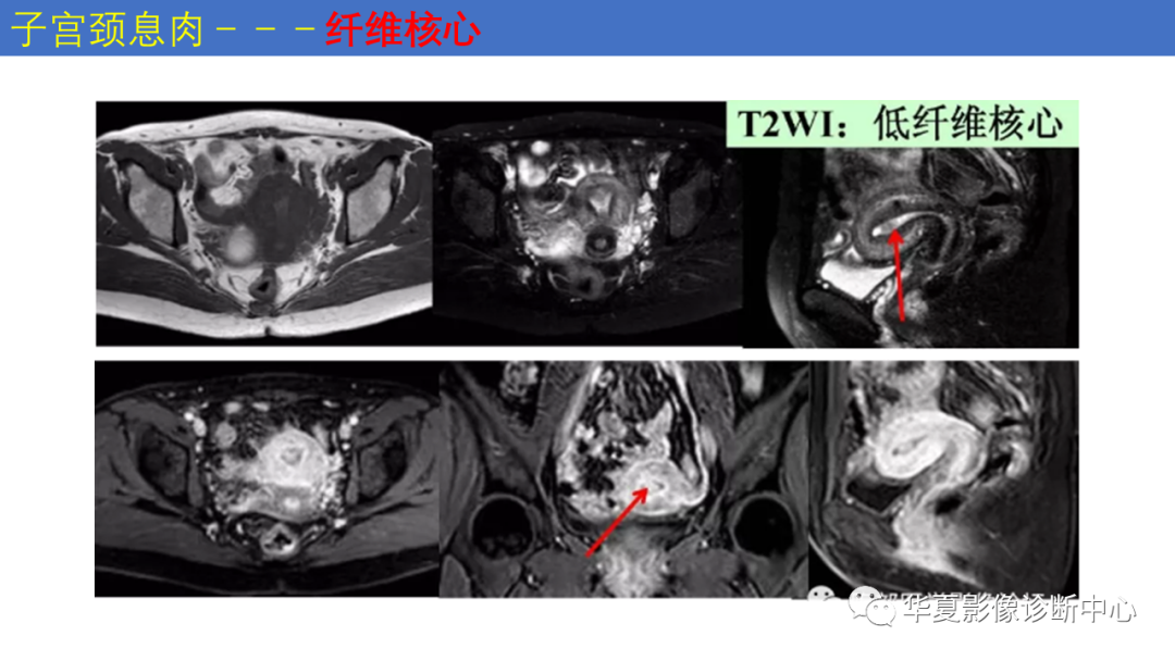 影像PPT - 【PPT】子宫内膜疾病的MRI诊断及鉴别-34