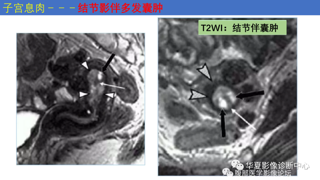 影像PPT - 【PPT】子宫内膜疾病的MRI诊断及鉴别-35