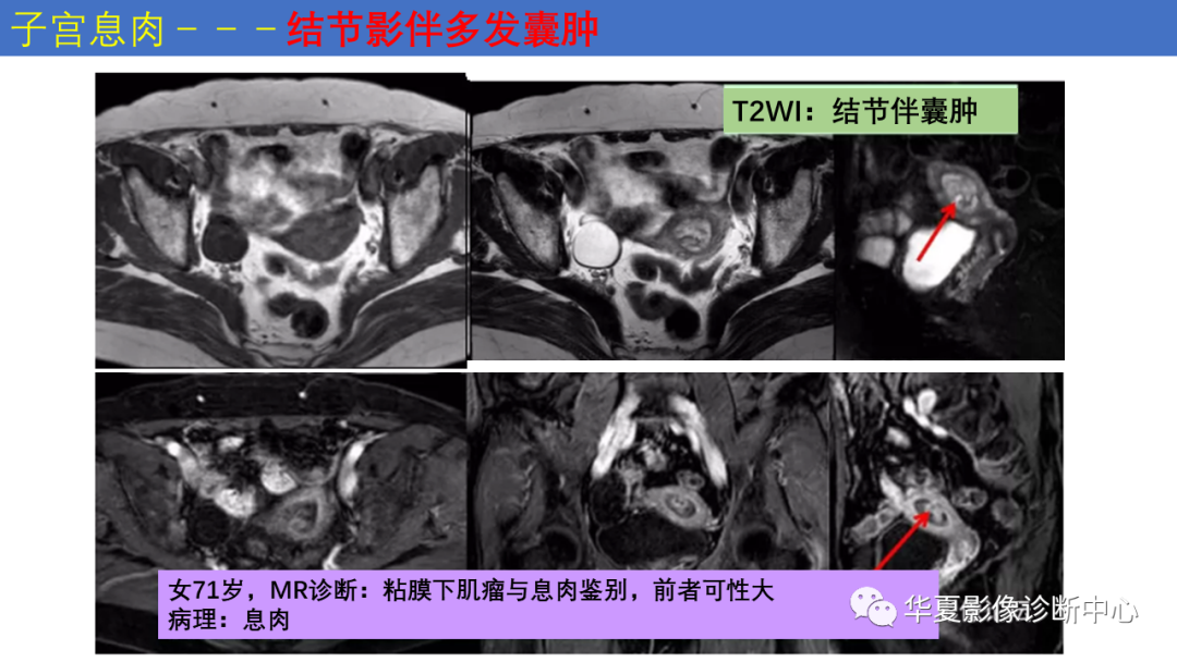 影像PPT - 【PPT】子宫内膜疾病的MRI诊断及鉴别-36