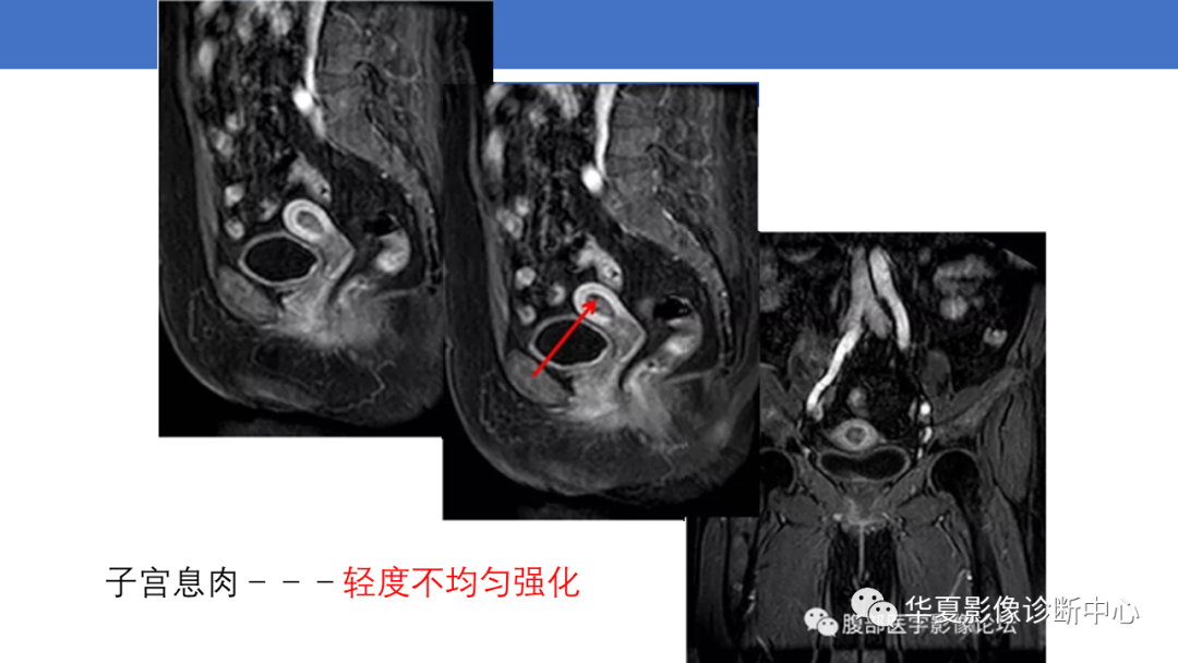 影像PPT - 【PPT】子宫内膜疾病的MRI诊断及鉴别-38