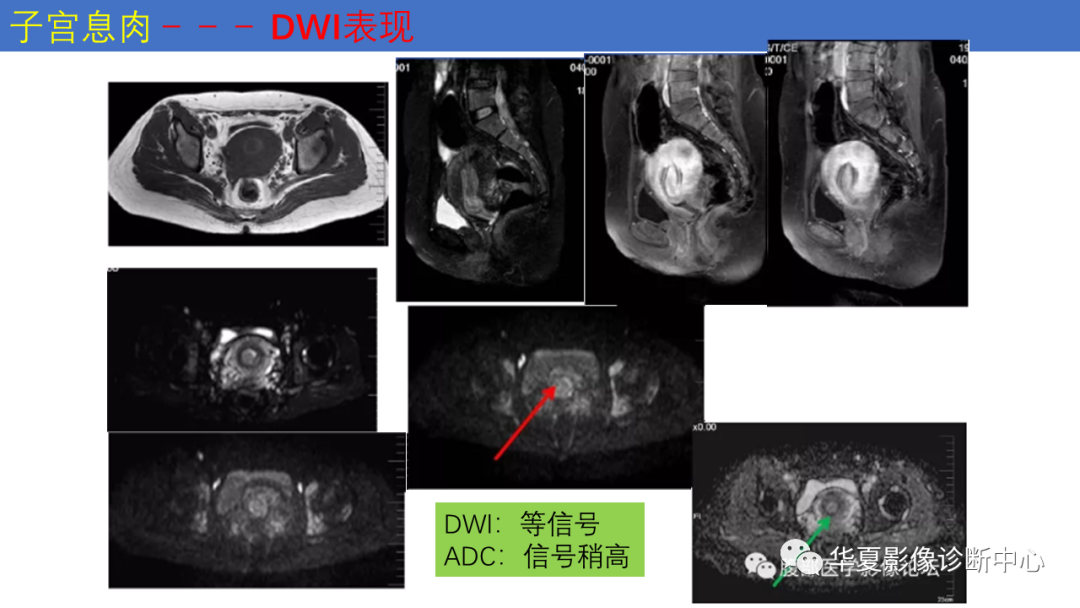 影像PPT - 【PPT】子宫内膜疾病的MRI诊断及鉴别-40