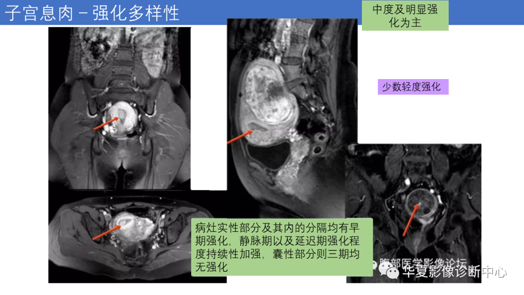 影像PPT - 【PPT】子宫内膜疾病的MRI诊断及鉴别-39