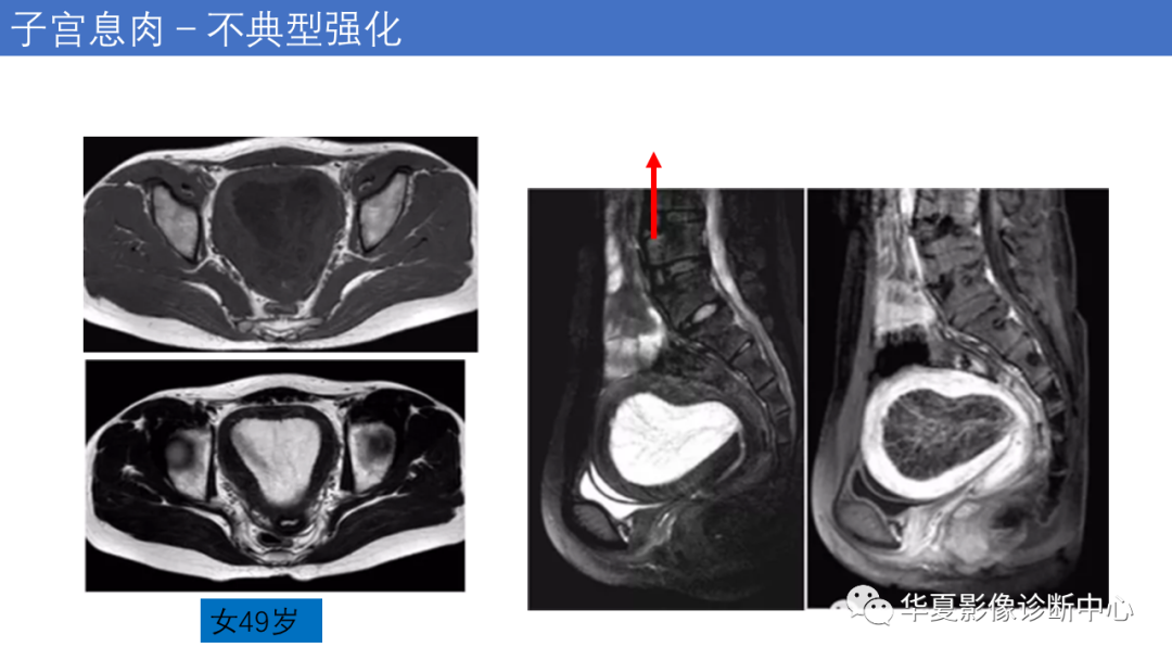 影像PPT - 【PPT】子宫内膜疾病的MRI诊断及鉴别-41