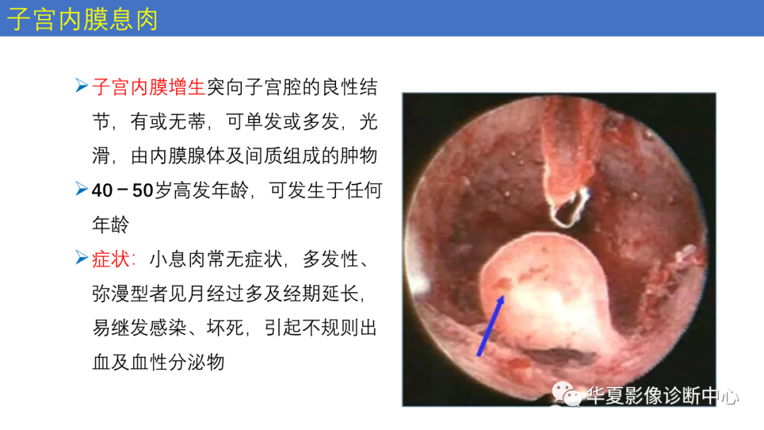 影像PPT - 【PPT】子宫内膜疾病的MRI诊断及鉴别-42