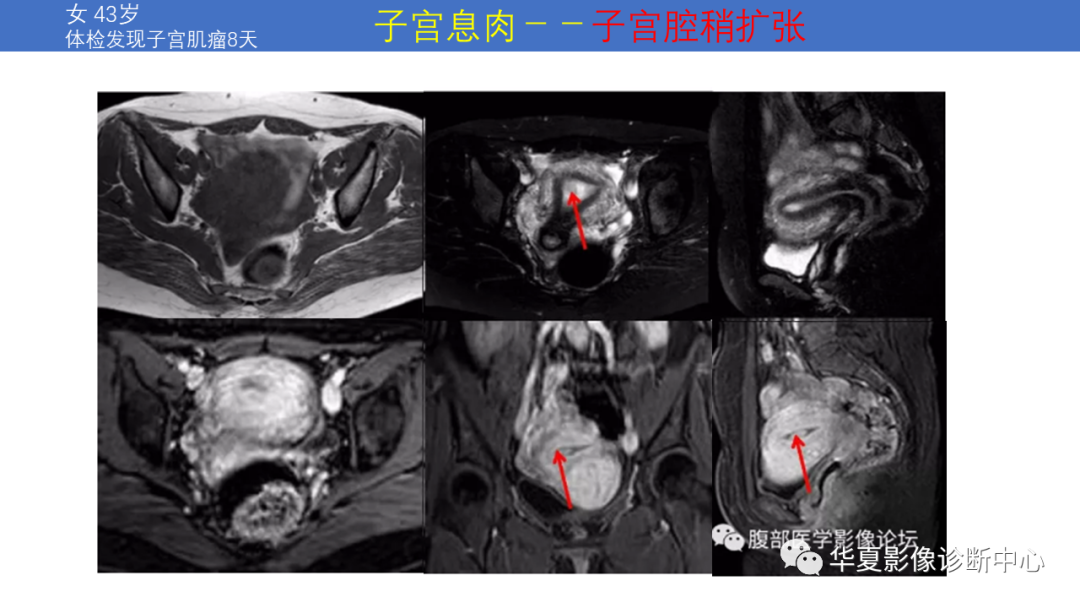 影像PPT - 【PPT】子宫内膜疾病的MRI诊断及鉴别-45