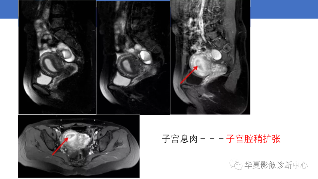 影像PPT - 【PPT】子宫内膜疾病的MRI诊断及鉴别-46