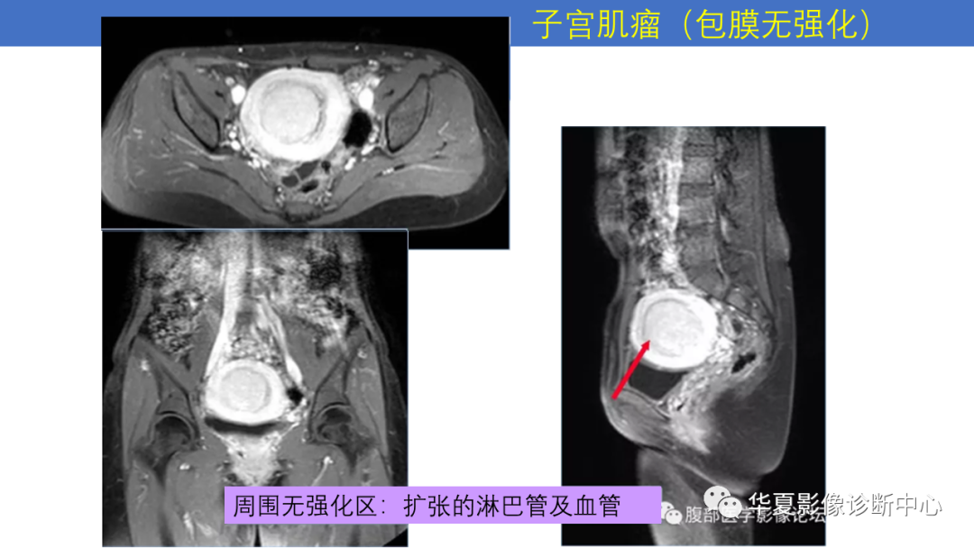影像PPT - 【PPT】子宫内膜疾病的MRI诊断及鉴别-48