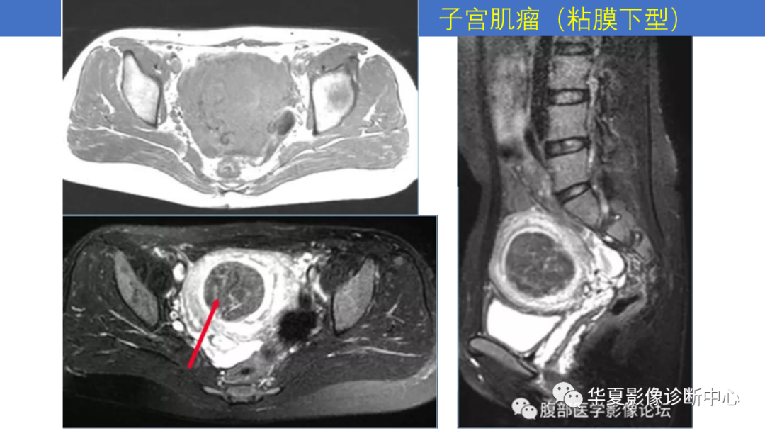 影像PPT - 【PPT】子宫内膜疾病的MRI诊断及鉴别-47