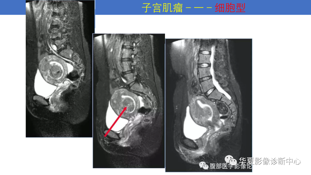影像PPT - 【PPT】子宫内膜疾病的MRI诊断及鉴别-49