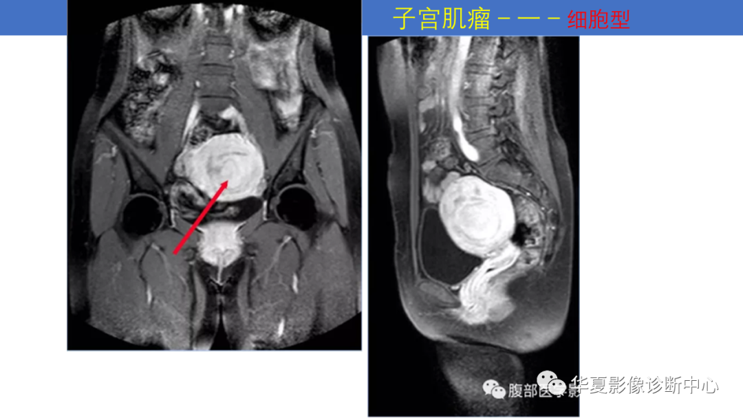 影像PPT - 【PPT】子宫内膜疾病的MRI诊断及鉴别-50