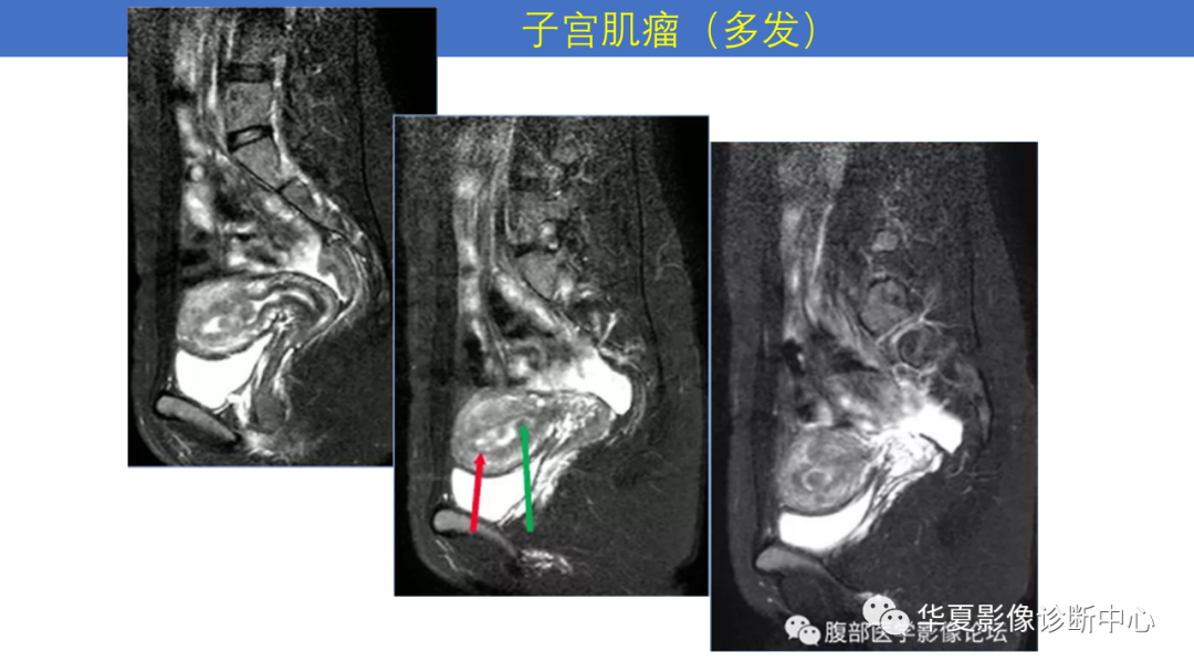 影像PPT - 【PPT】子宫内膜疾病的MRI诊断及鉴别-51