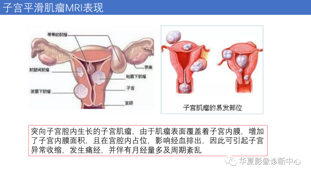 影像PPT - 【PPT】子宫内膜疾病的MRI诊断及鉴别-52