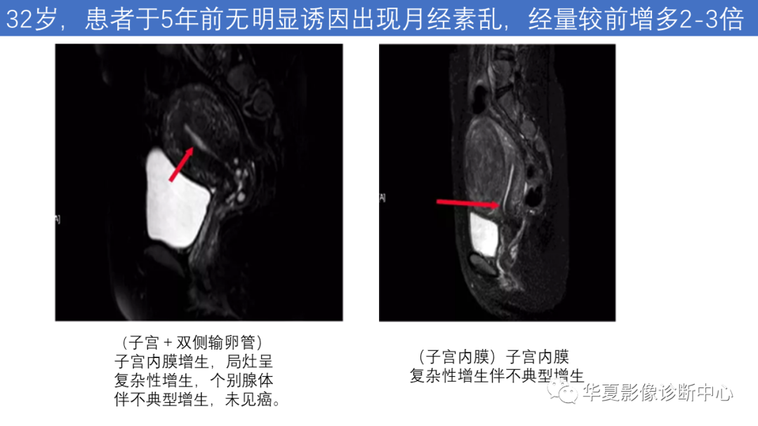 影像PPT - 【PPT】子宫内膜疾病的MRI诊断及鉴别-57