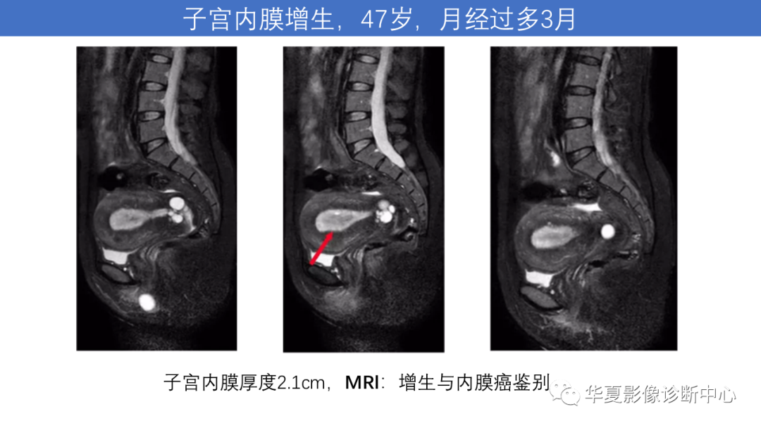 影像PPT - 【PPT】子宫内膜疾病的MRI诊断及鉴别-56