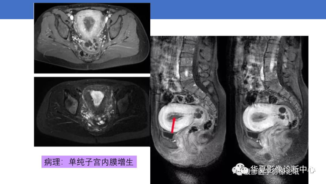 影像PPT - 【PPT】子宫内膜疾病的MRI诊断及鉴别-58