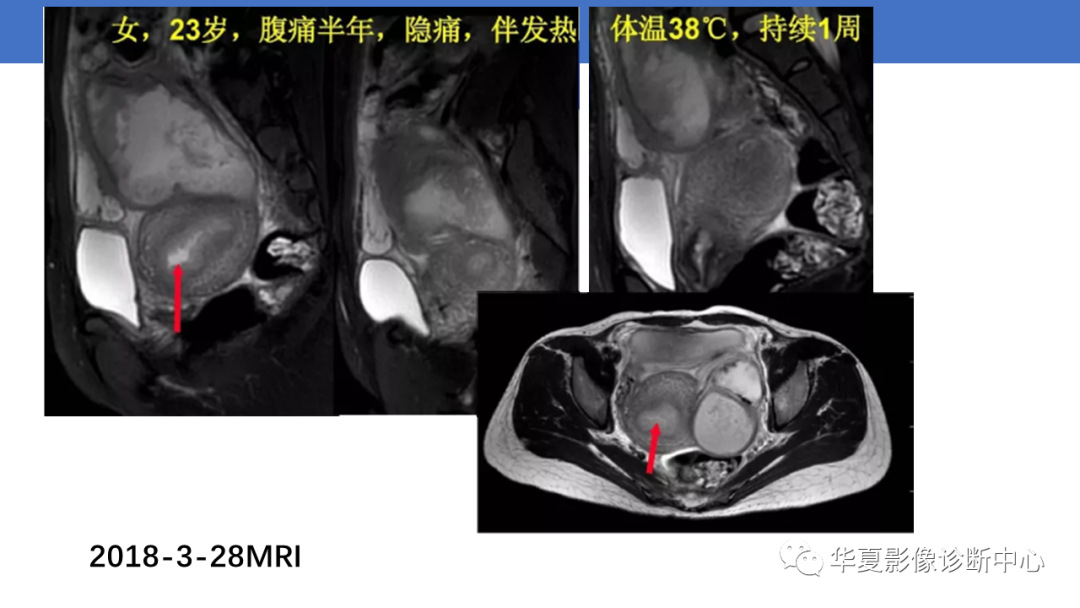 影像PPT - 【PPT】子宫内膜疾病的MRI诊断及鉴别-59