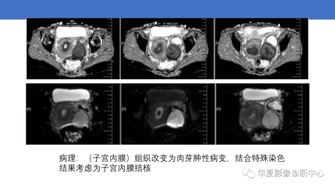 影像PPT - 【PPT】子宫内膜疾病的MRI诊断及鉴别-62