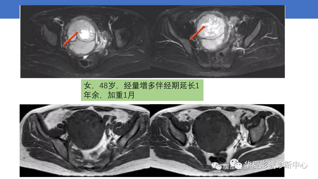 影像PPT - 【PPT】子宫内膜疾病的MRI诊断及鉴别-65