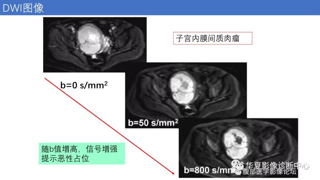影像PPT - 【PPT】子宫内膜疾病的MRI诊断及鉴别-67