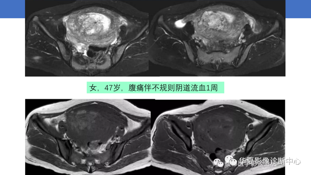影像PPT - 【PPT】子宫内膜疾病的MRI诊断及鉴别-68