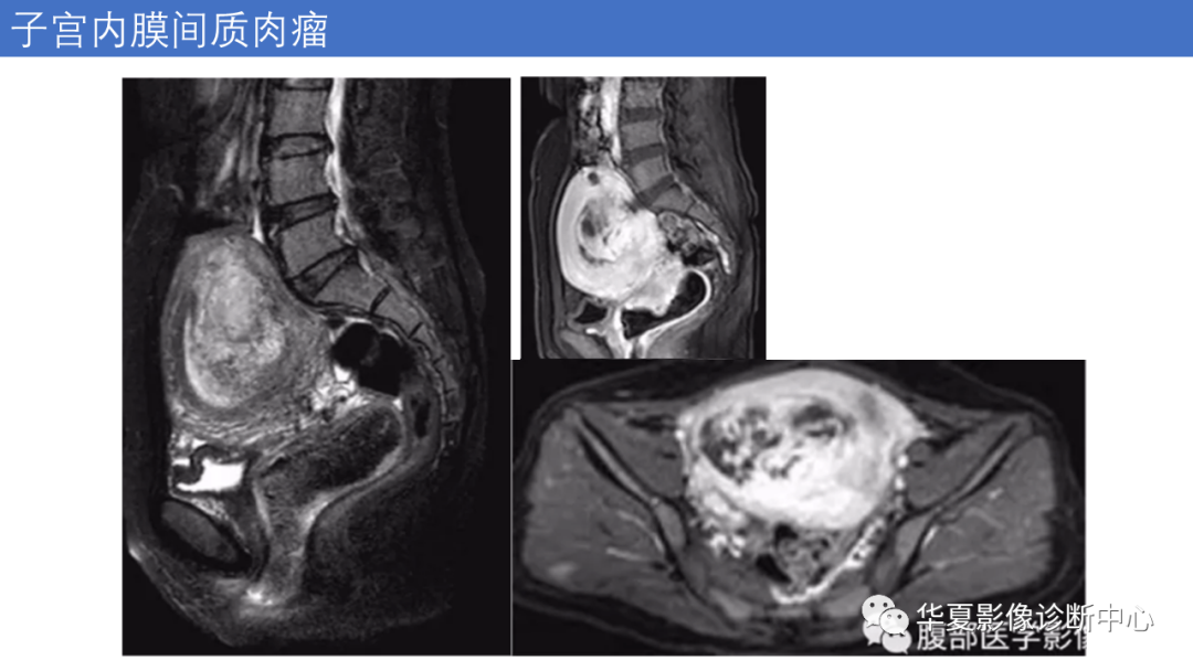 影像PPT - 【PPT】子宫内膜疾病的MRI诊断及鉴别-69