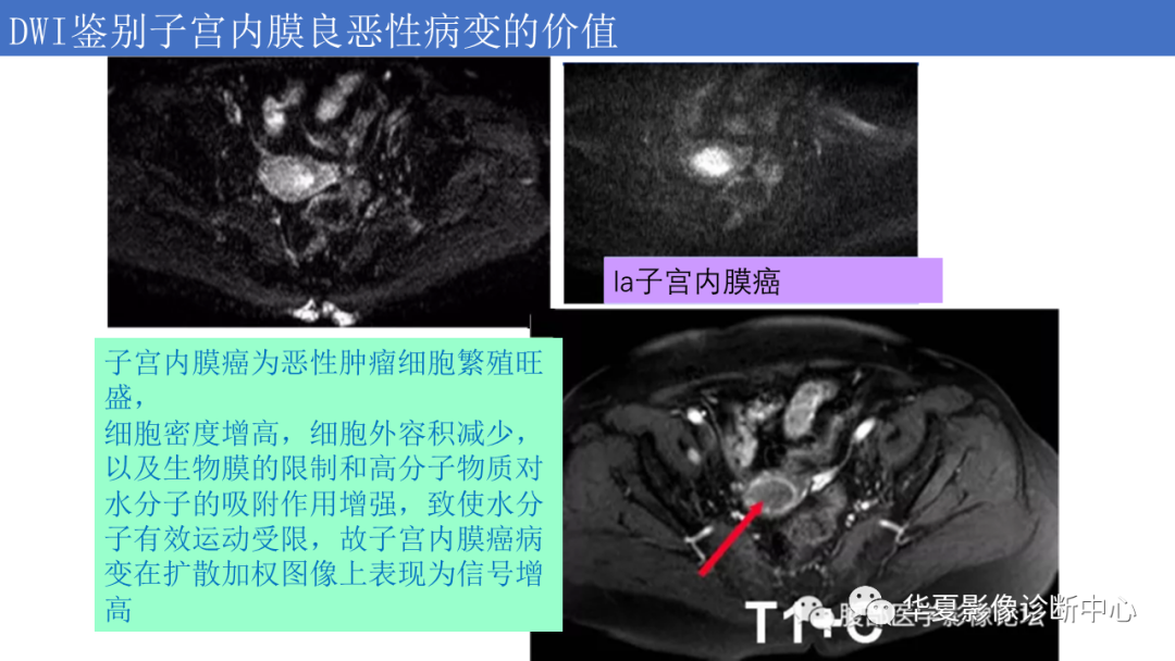 影像PPT - 【PPT】子宫内膜疾病的MRI诊断及鉴别-71
