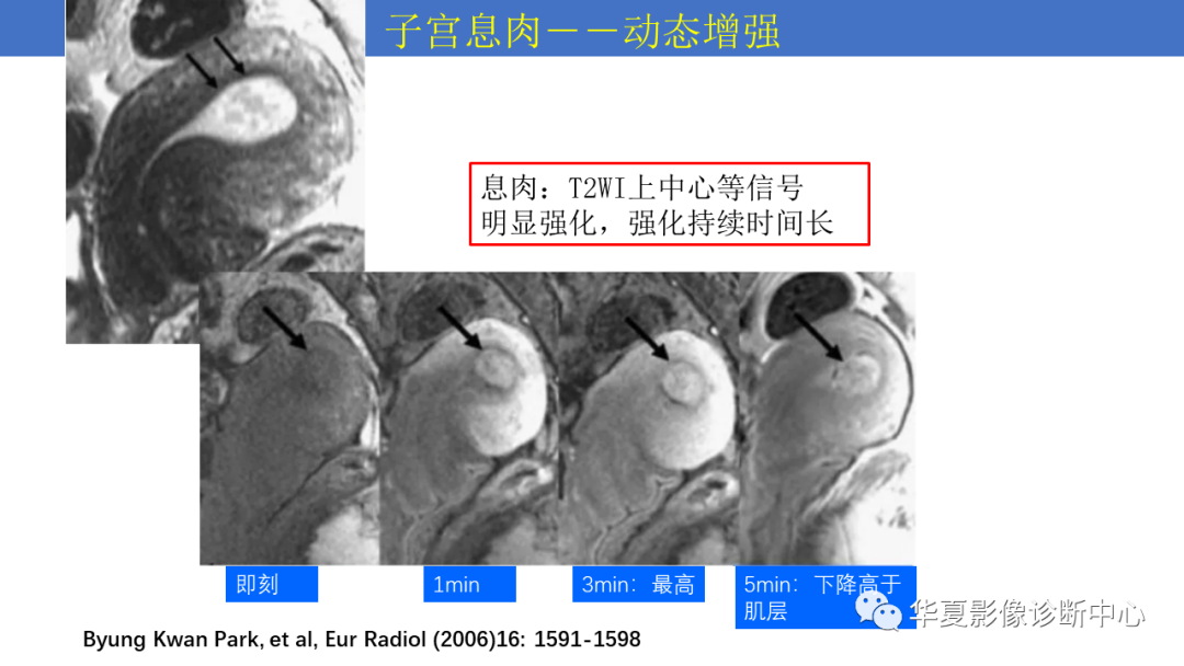 影像PPT - 【PPT】子宫内膜疾病的MRI诊断及鉴别-74