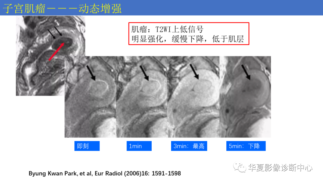 影像PPT - 【PPT】子宫内膜疾病的MRI诊断及鉴别-75