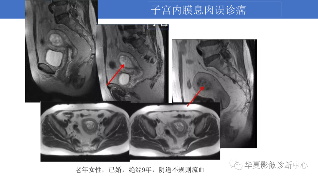 影像PPT - 【PPT】子宫内膜疾病的MRI诊断及鉴别-78