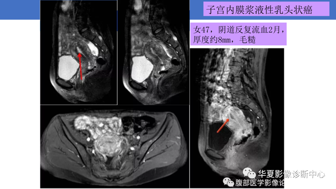 影像PPT - 【PPT】子宫内膜疾病的MRI诊断及鉴别-82