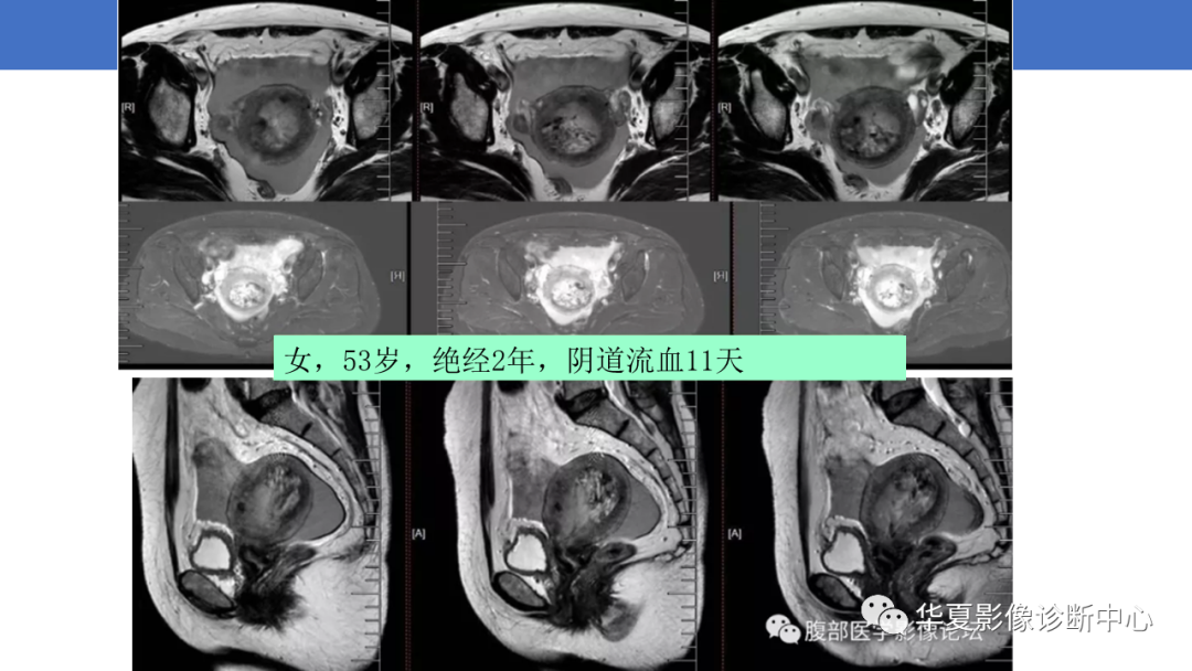 影像PPT - 【PPT】子宫内膜疾病的MRI诊断及鉴别-84