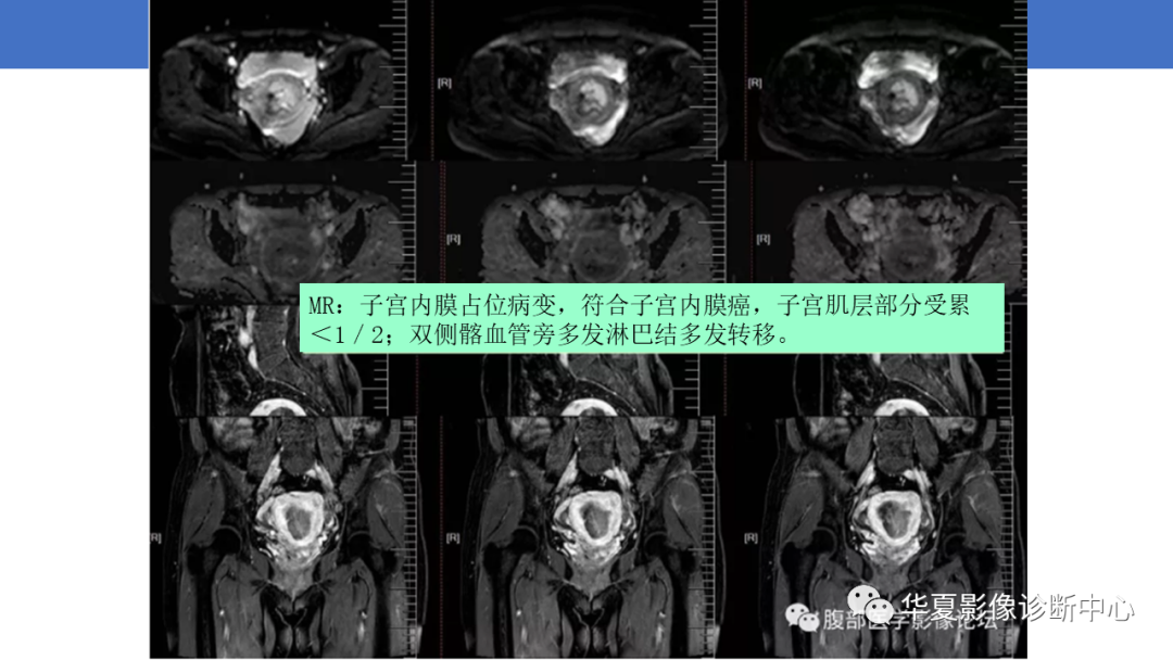 影像PPT - 【PPT】子宫内膜疾病的MRI诊断及鉴别-85
