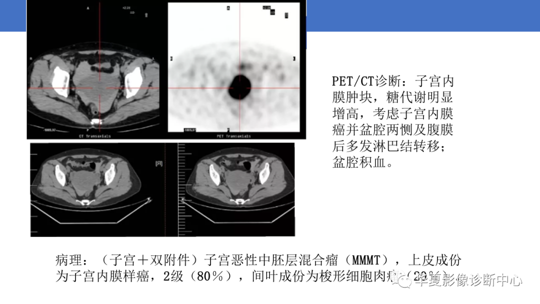 影像PPT - 【PPT】子宫内膜疾病的MRI诊断及鉴别-86