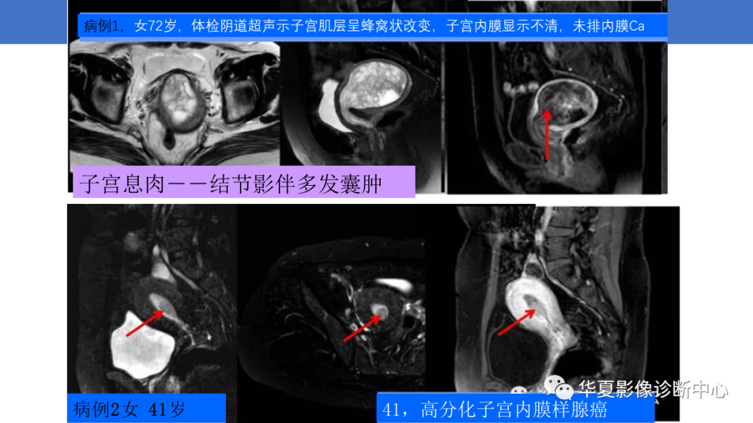 影像PPT - 【PPT】子宫内膜疾病的MRI诊断及鉴别-88